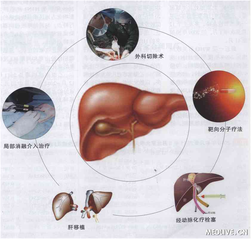 综述：病毒相关性肝细胞癌的防治