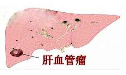 发现肝血管瘤该怎么办？