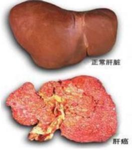 乙肝到肝癌会经历哪些过程？