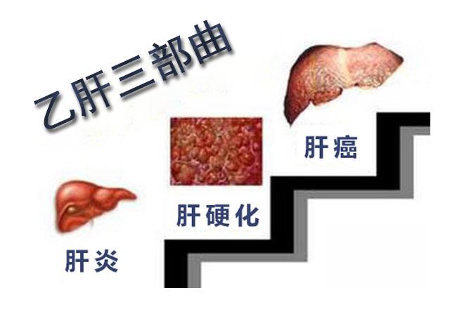 怎样防止乙肝癌变？