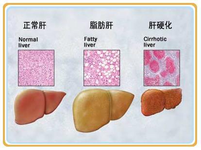 预防乙肝变肝癌需要做什么？