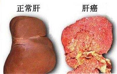 谷氨酰转肽酶偏高会是肝癌吗？