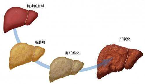 脂肪肝能自愈吗？