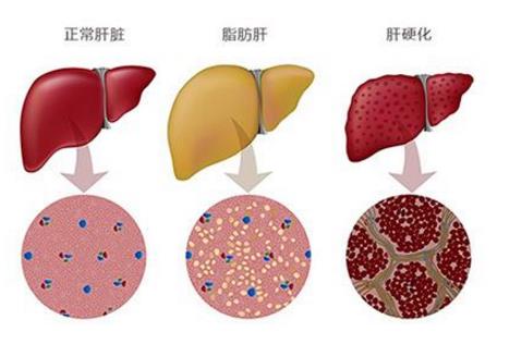 乙肝小三阳脸色越来越黄是怎么回事？