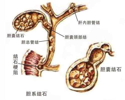 27肝脏内有胆管结石怎么办？