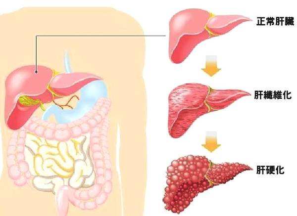 肝硬化对人体有什么伤害？