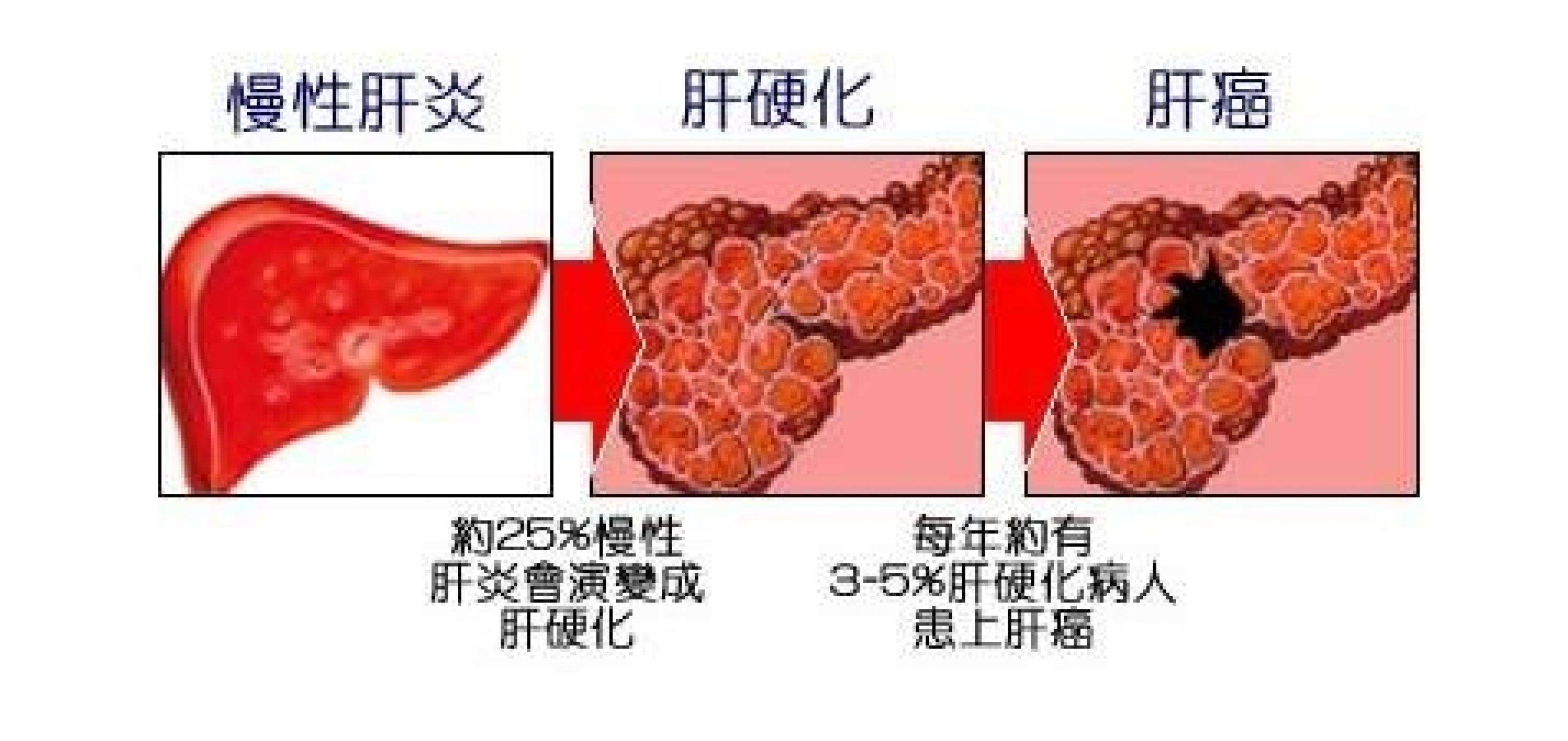 乙肝小三阳癌变的几率大吗？