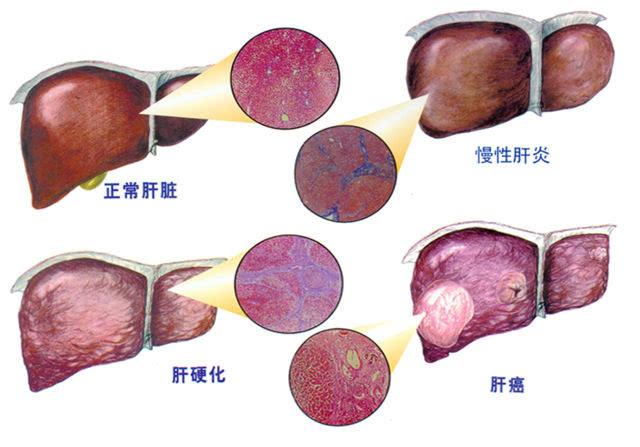 乙肝抗纤维化与抗病毒能同步进行吗？