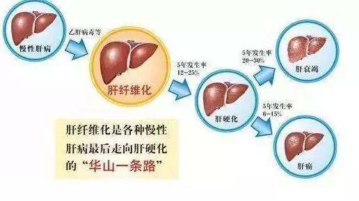 乙肝抗纤维化与抗病毒能同步进行吗？