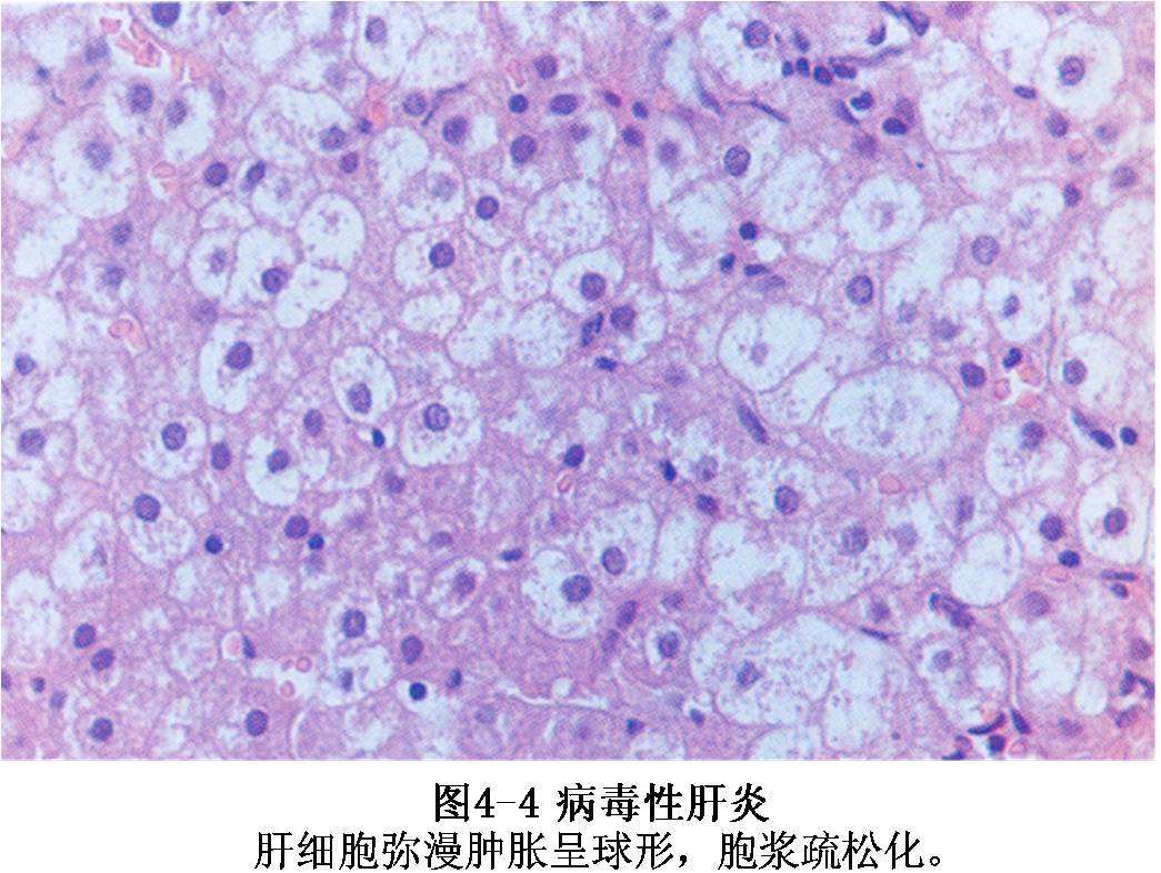 病毒性肝炎是乙肝吗？