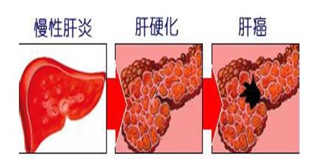 乙肝肝硬化还能活多久？