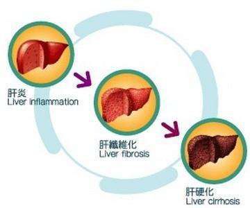 乙肝容易恶化成肝癌有哪些因素？