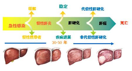 乙肝肝硬化患者生活中如何预防肝硬化恶化？