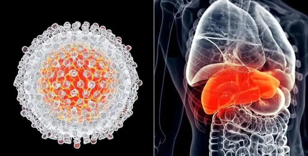肝炎容易发展成肝癌